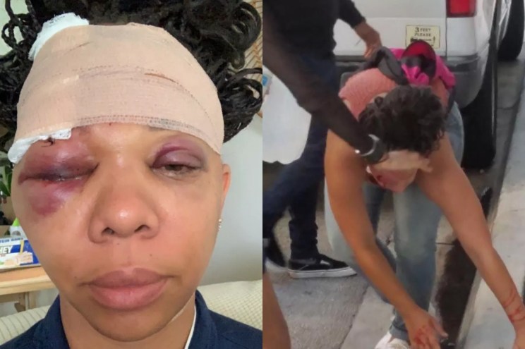 SIde-by-side images of (left) LaToya Ratlieff's swollen face after she was struck by a rubber bullet and (right) Ratlieff bleeding after she was hit.